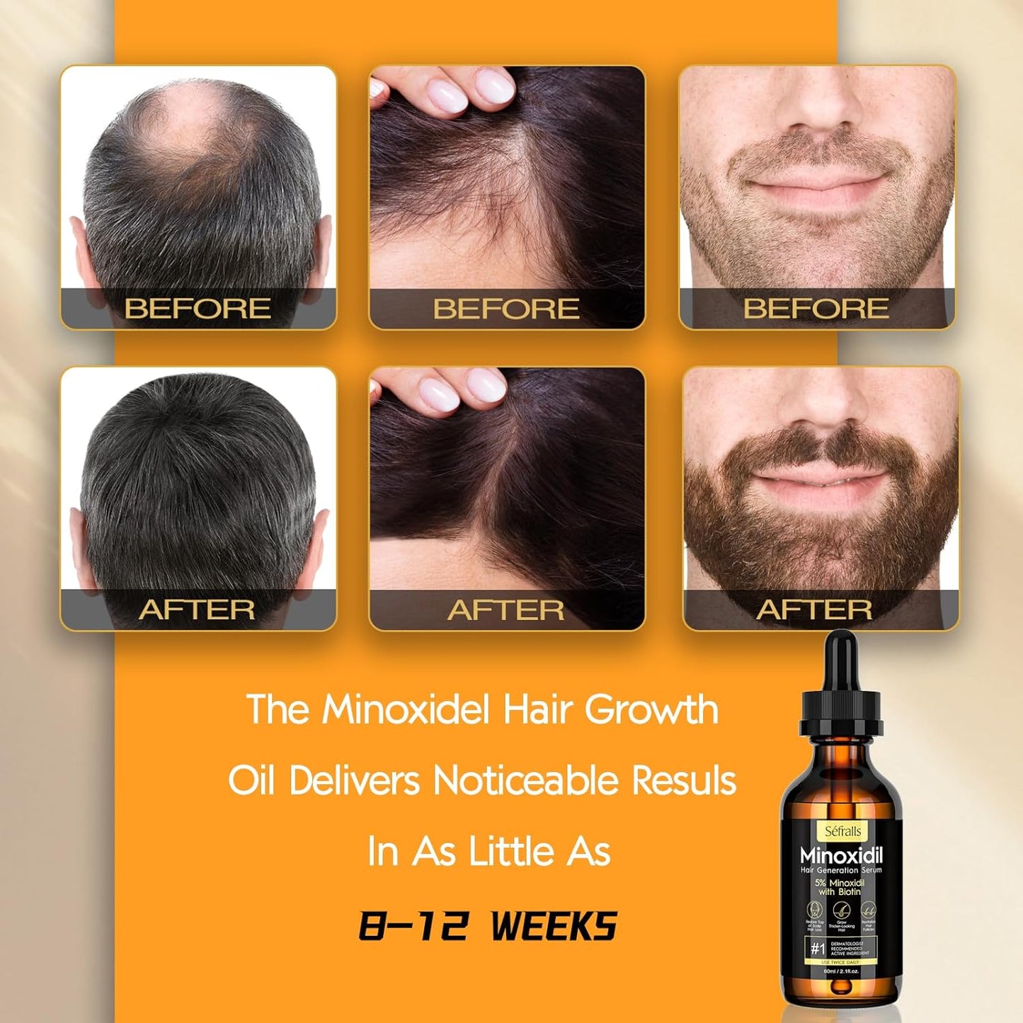 5% Minoxidil Hair Growth Oil for Men and Women – Extra Strength Hair Regrowth Serum, Topical Treatment for Hair Loss, Supports Thicker, Healthier Hair & Beard Growth, 2.11 Fl Oz